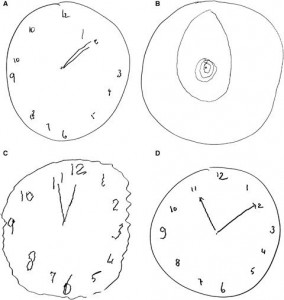 Clock-Drawing Test examples